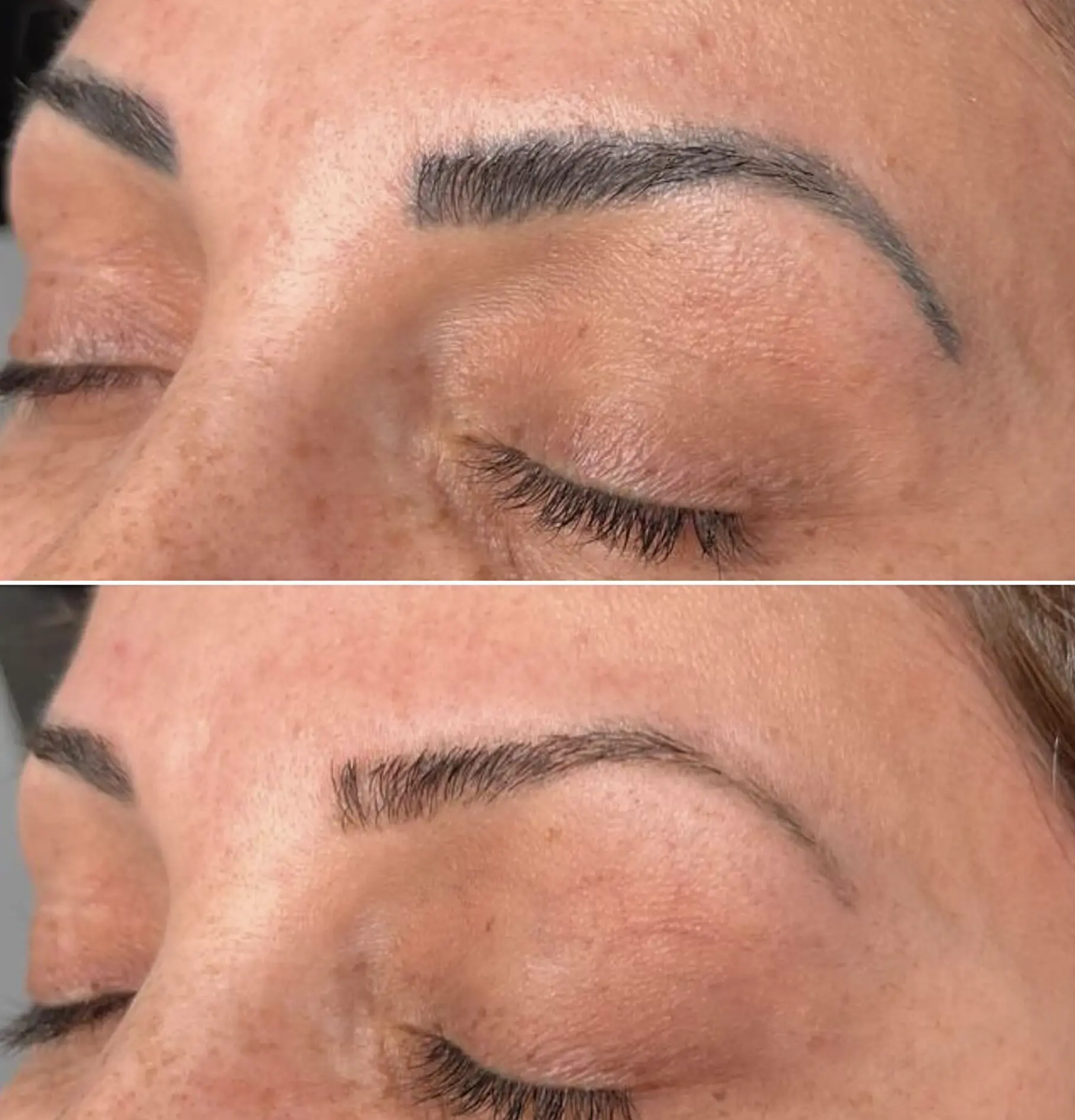 cosmetic tattoo removal