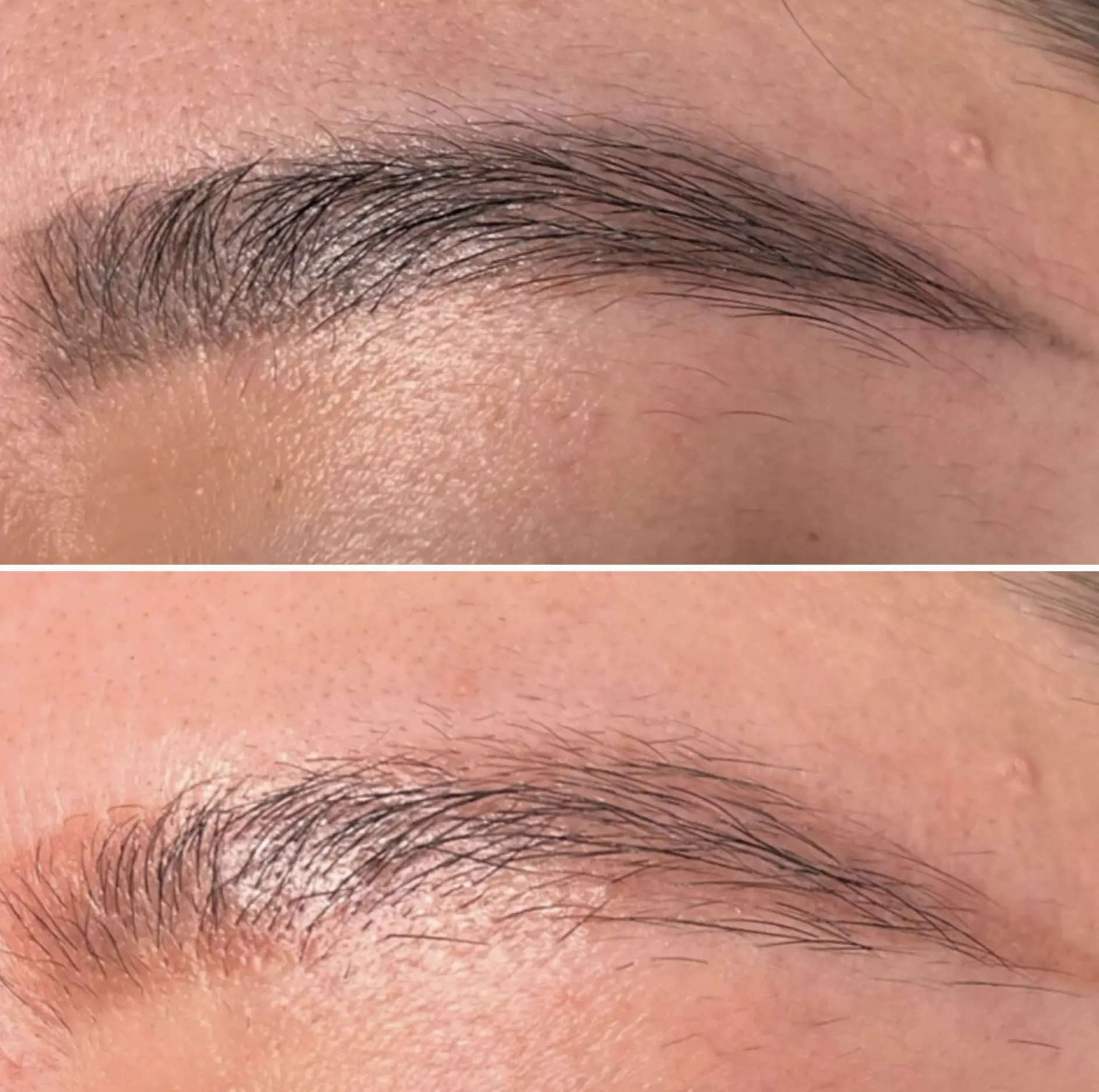 non-laser tattoo removal