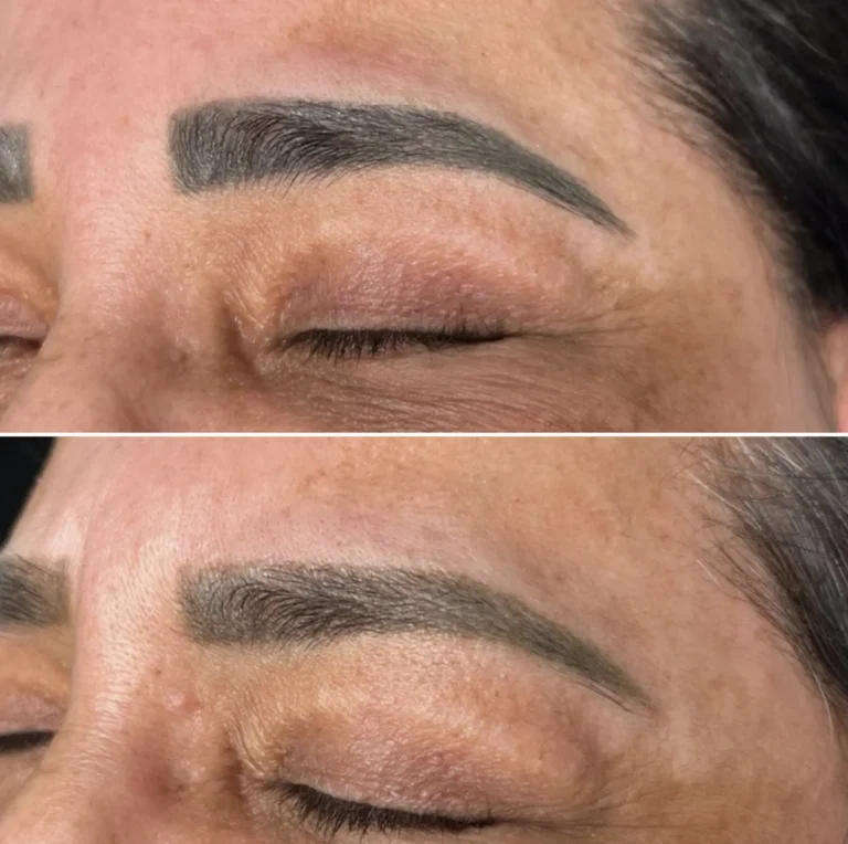 What’s the Process for Removing Brow Tattoos with Saline