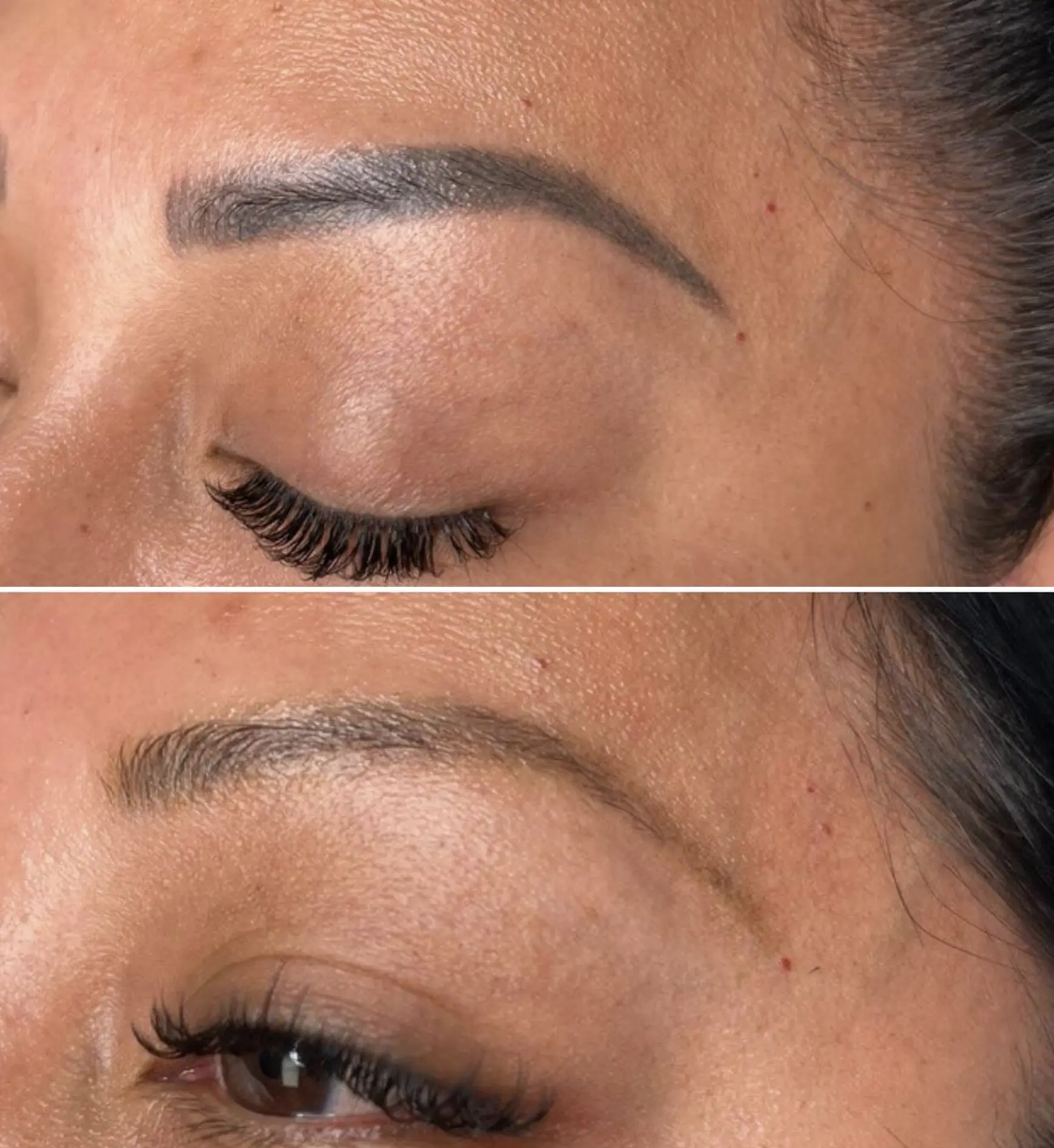 saline tattoo removal Melbourne