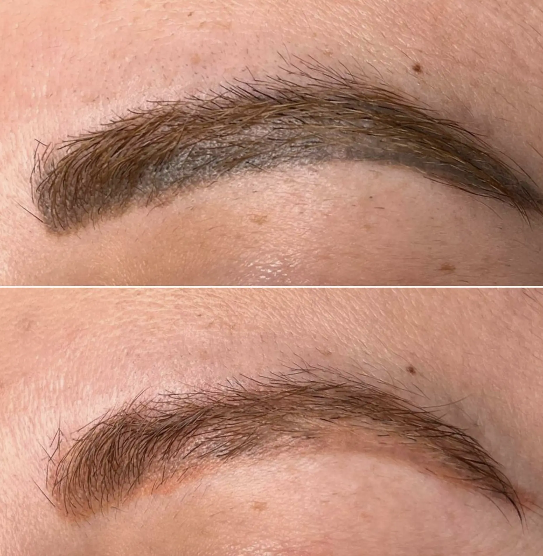 tattoo removal healing stages